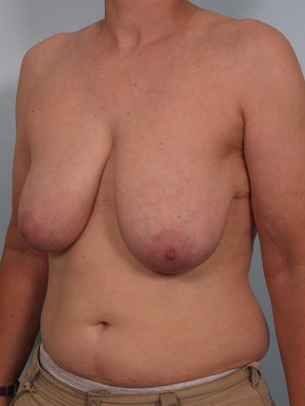 Breast Lift Before & After Gallery - Patient 1310511 - Image 5