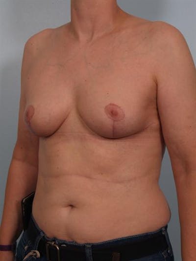 Breast Lift Before & After Gallery - Patient 1310511 - Image 6