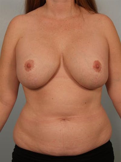 Complex Breast Revision Before & After Gallery - Patient 1310514 - Image 1