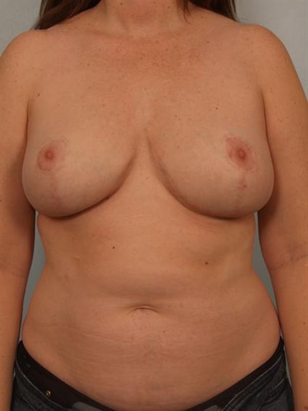 Complex Breast Revision Gallery - Patient 1310514 - Image 2