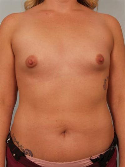 Tuberous Breast Surgery Before & After Gallery - Patient 1310515 - Image 1