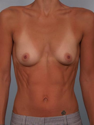 Breast Augmentation Before & After Gallery - Patient 1310517 - Image 1