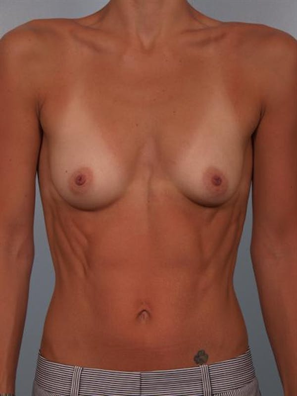 Breast Augmentation Before & After Gallery - Patient 1310517 - Image 1