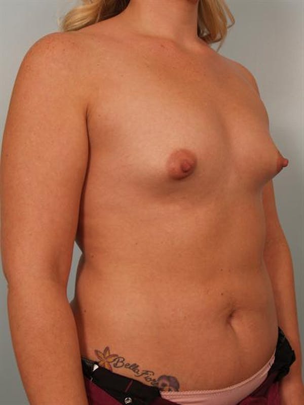 Tuberous Breast Surgery Before & After Gallery - Patient 1310515 - Image 3