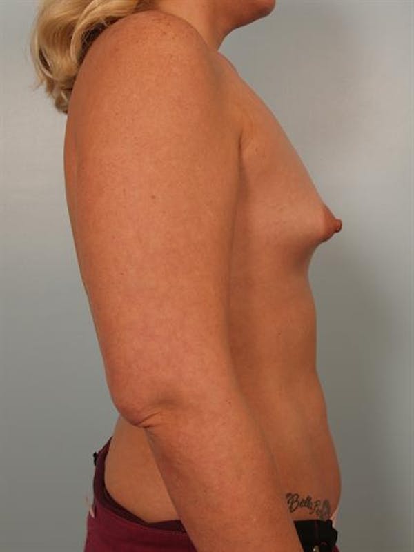 Tuberous Breast Surgery Before & After Gallery - Patient 1310515 - Image 5