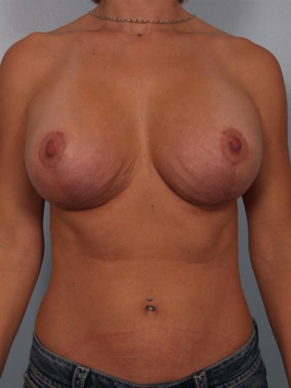 Complex Breast Revision Before & After Gallery - Patient 1310518 - Image 2