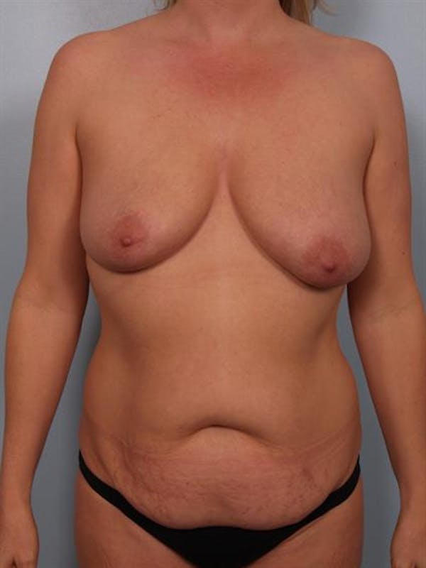 Breast Lift Before & After Gallery - Patient 1310520 - Image 1