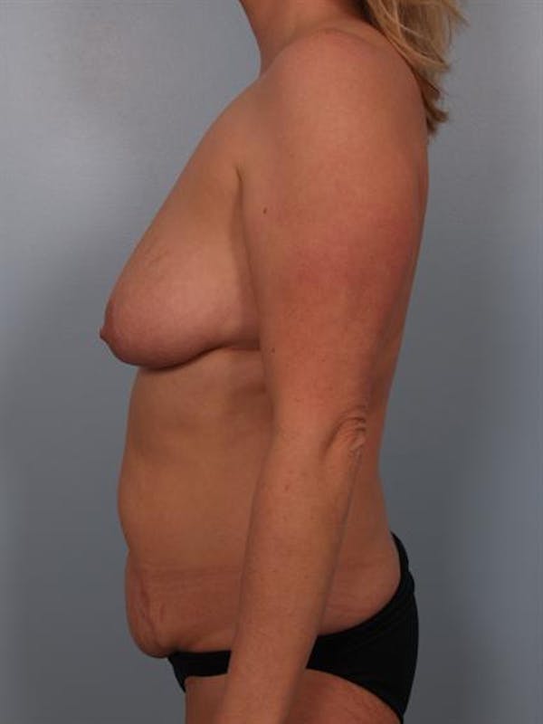 Breast Lift Before & After Gallery - Patient 1310520 - Image 5