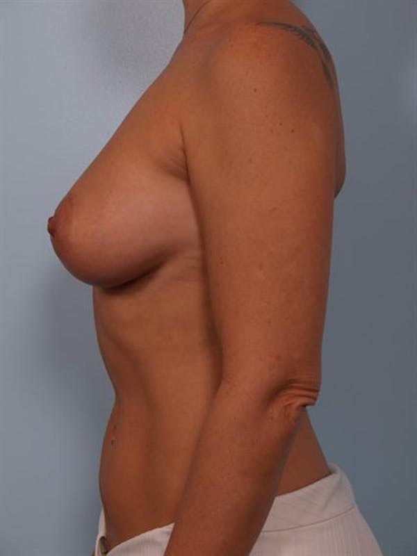 Breast Augmentation Before & After Gallery - Patient 1310521 - Image 4