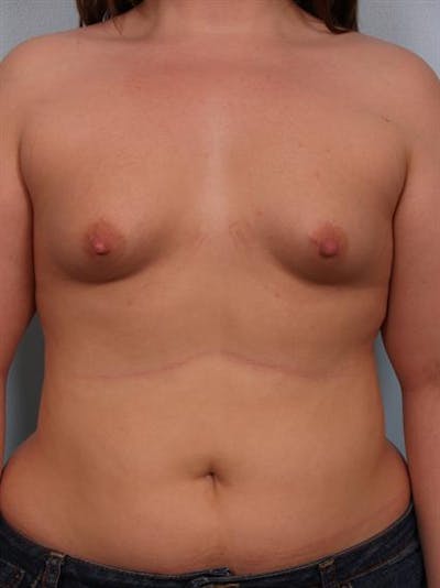 Tuberous Breast Surgery Before & After Gallery - Patient 1310522 - Image 1