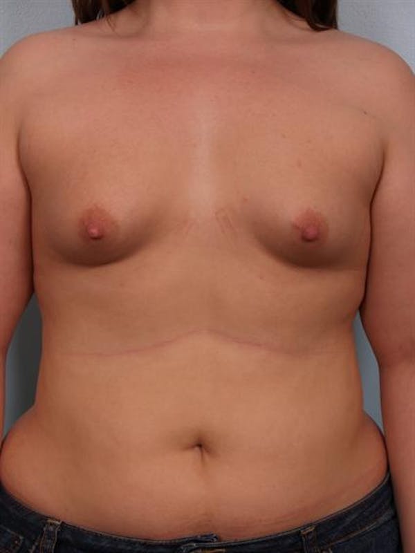 Tuberous Breast Surgery Gallery - Patient 1310522 - Image 1