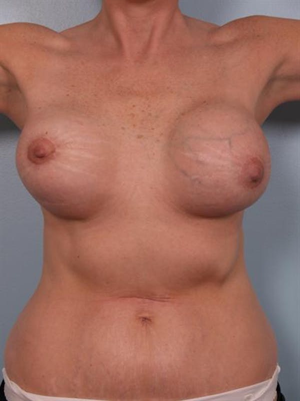 Breast Lift Before & After Gallery - Patient 1310524 - Image 1