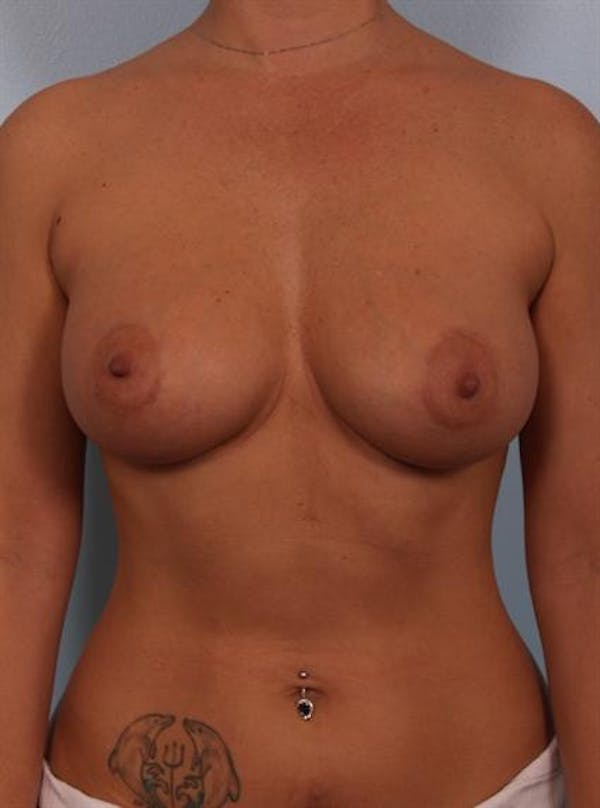 Breast Augmentation Gallery - Patient 1310521 - Image 6