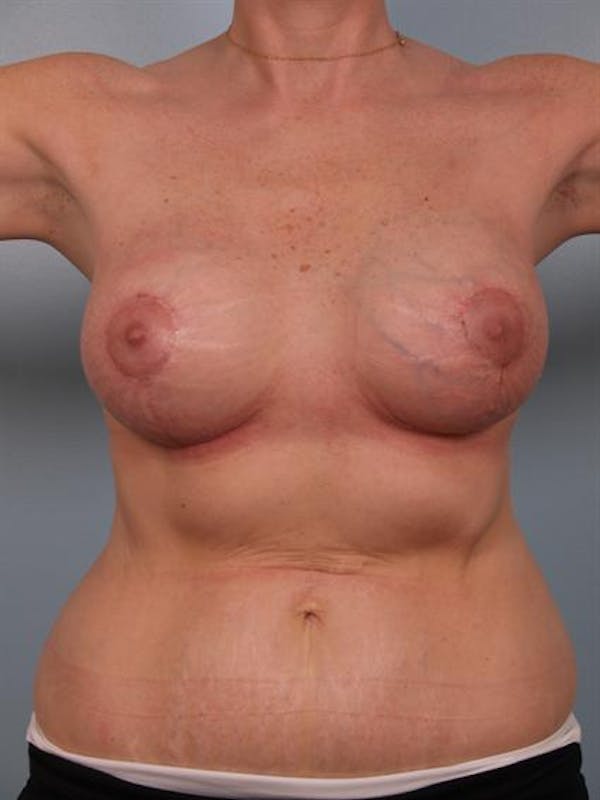 Breast Lift Before & After Gallery - Patient 1310524 - Image 2