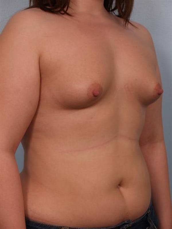 Tuberous Breast Surgery Before & After Gallery - Patient 1310522 - Image 5
