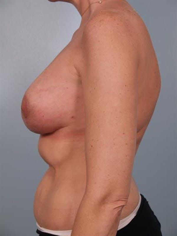 Breast Lift Before & After Gallery - Patient 1310524 - Image 4