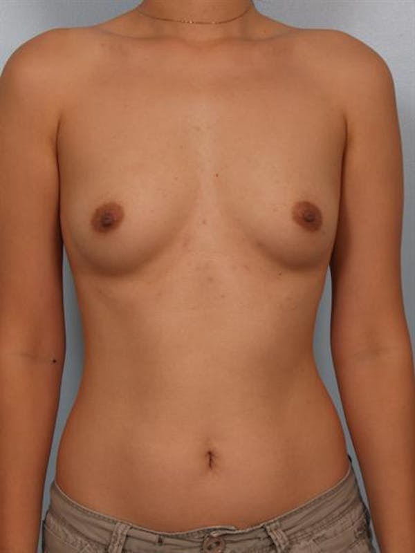 Breast Augmentation Before & After Gallery - Patient 1310527 - Image 1