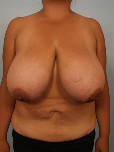 Breast Reduction Before & After Gallery - Patient 1310526 - Image 1