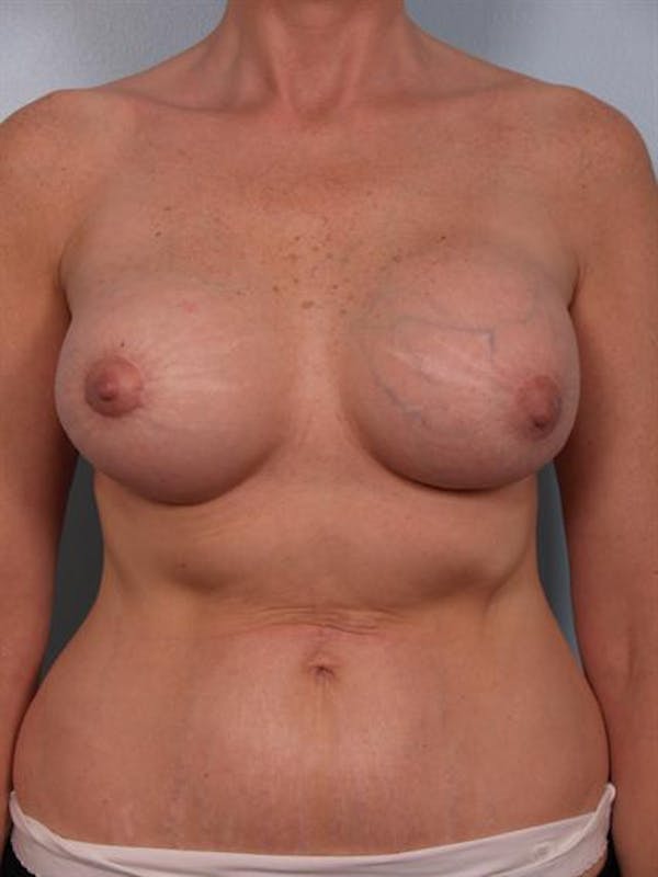 Breast Lift Gallery - Patient 1310524 - Image 7