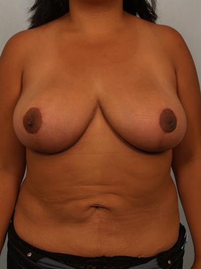 Breast Reduction Before & After Gallery - Patient 1310526 - Image 2