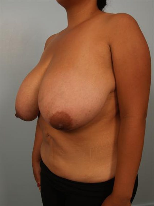 Breast Reduction Gallery - Patient 1310526 - Image 3