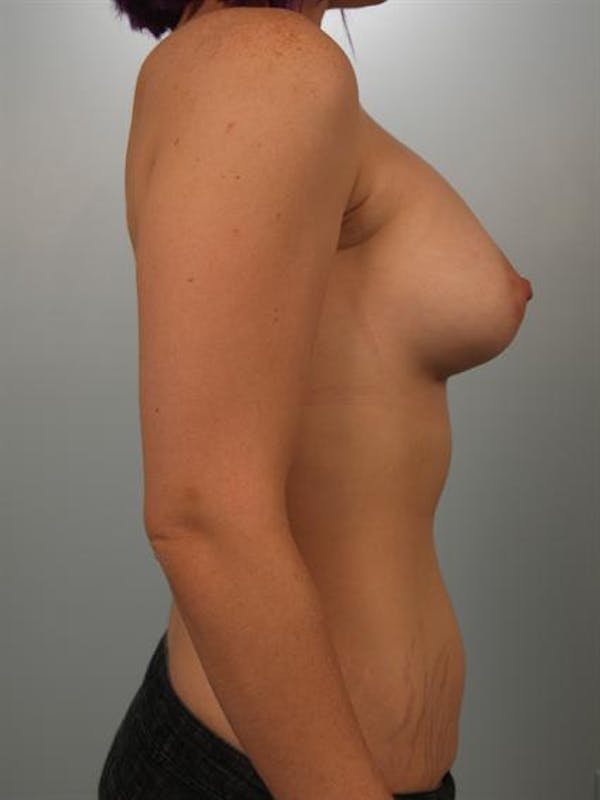 Tuberous Breast Surgery Before & After Gallery - Patient 1310525 - Image 6