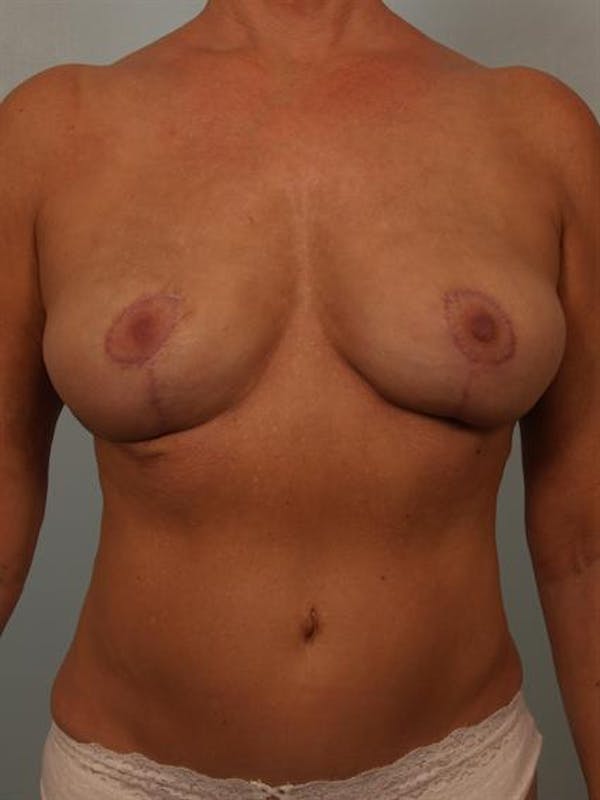 Complex Breast Revision Before & After Gallery - Patient 1310528 - Image 2