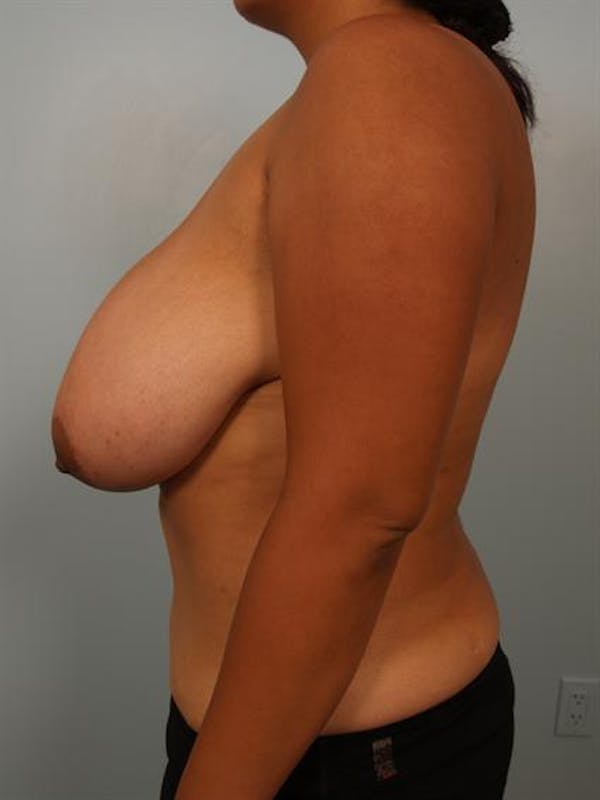 Breast Reduction Before & After Gallery - Patient 1310526 - Image 5