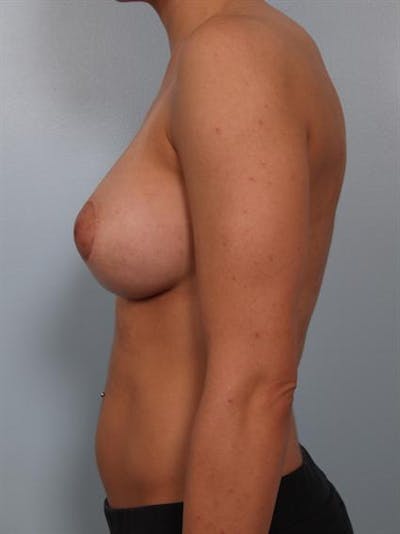 Tuberous Breast Surgery Before & After Gallery - Patient 1310530 - Image 4