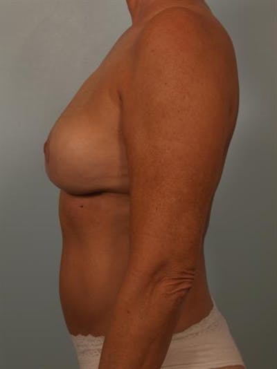 Complex Breast Revision Before & After Gallery - Patient 1310528 - Image 6