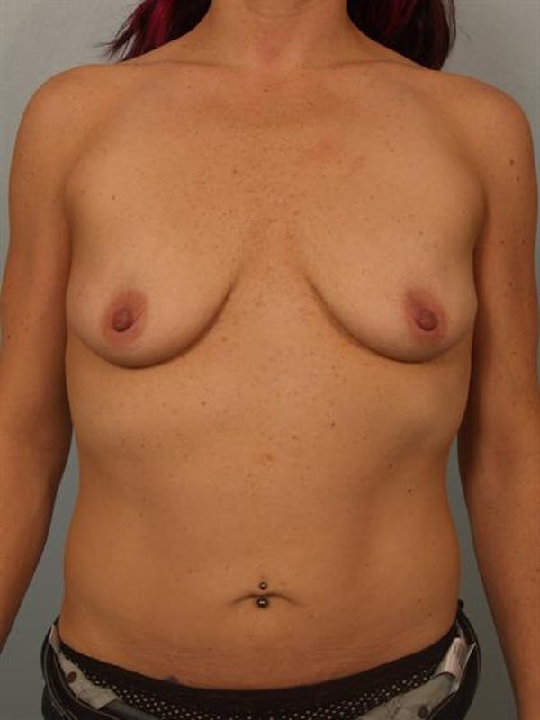 Breast Lift Before & After Gallery - Patient 1310531 - Image 1