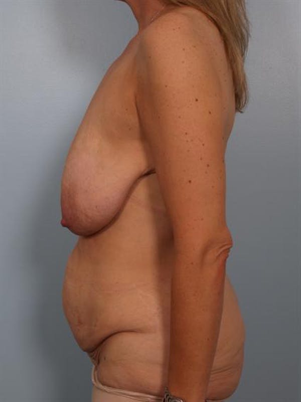 Breast Reduction Before & After Gallery - Patient 1310532 - Image 3
