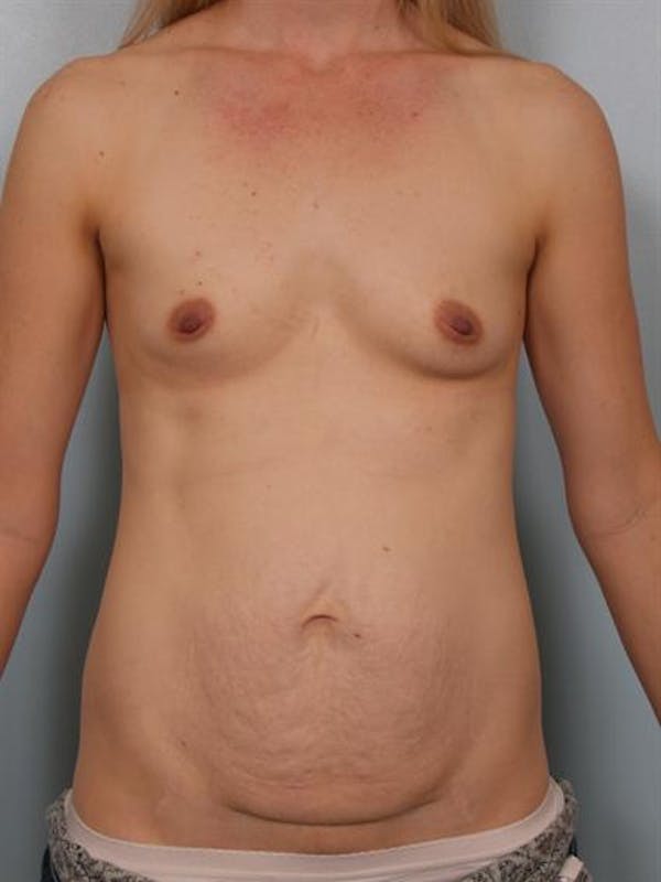 Breast Augmentation Gallery - Patient 1310534 - Image 3