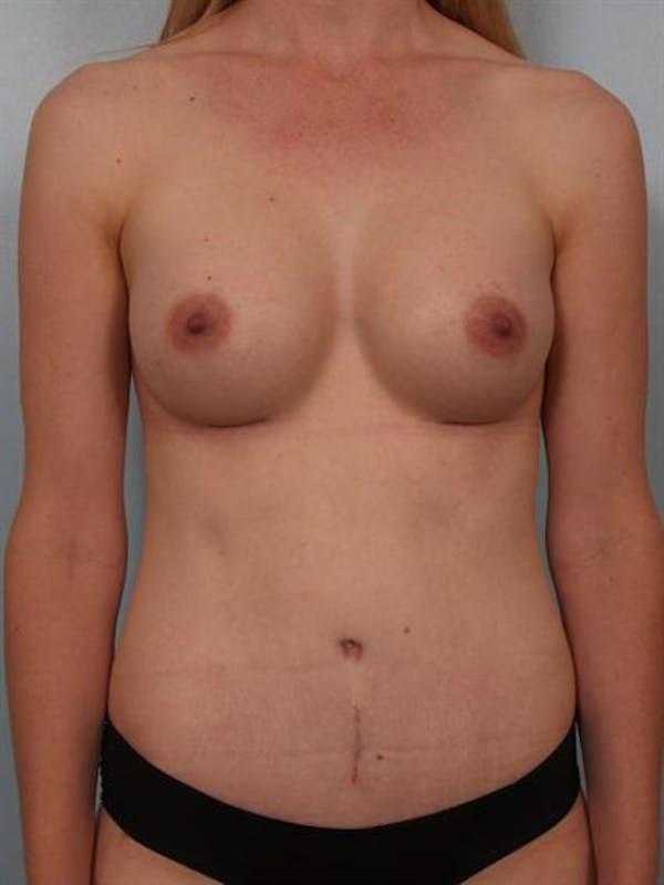 Breast Augmentation Before & After Gallery - Patient 1310534 - Image 4