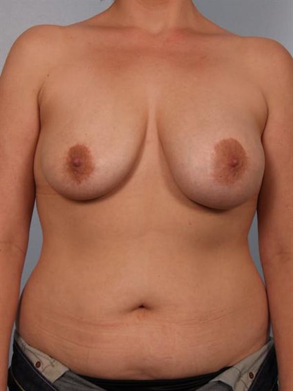 Complex Breast Revision Before & After Gallery - Patient 1310533 - Image 1