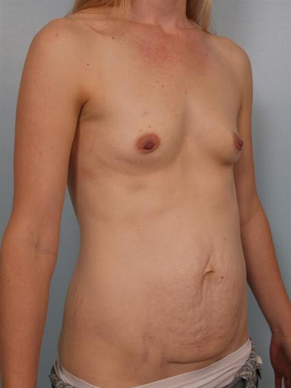 Breast Augmentation Before & After Gallery - Patient 1310534 - Image 5