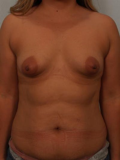 Tuberous Breast Surgery Before & After Gallery - Patient 1310535 - Image 1
