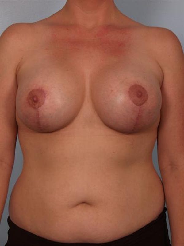 Complex Breast Revision Before & After Gallery - Patient 1310533 - Image 2