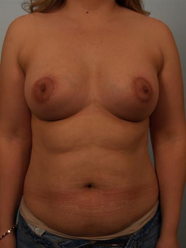 Tuberous Breast Surgery Before & After Gallery - Patient 1310535 - Image 2