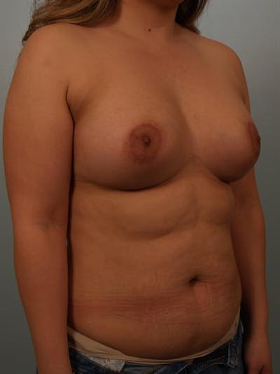 Tuberous Breast Surgery Gallery - Patient 1310535 - Image 6