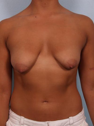 Tuberous Breast Surgery Before & After Gallery - Patient 1310539 - Image 1