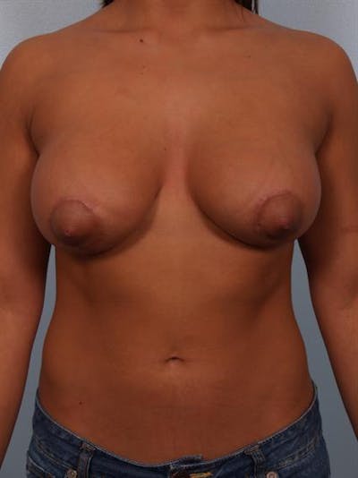 Tuberous Breast Surgery Before & After Gallery - Patient 1310539 - Image 2