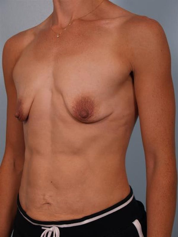 Breast Lift Before & After Gallery - Patient 1310542 - Image 3