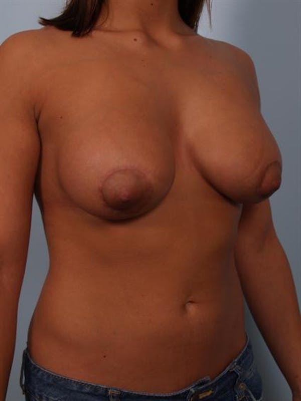 Tuberous Breast Surgery Before & After Gallery - Patient 1310539 - Image 4