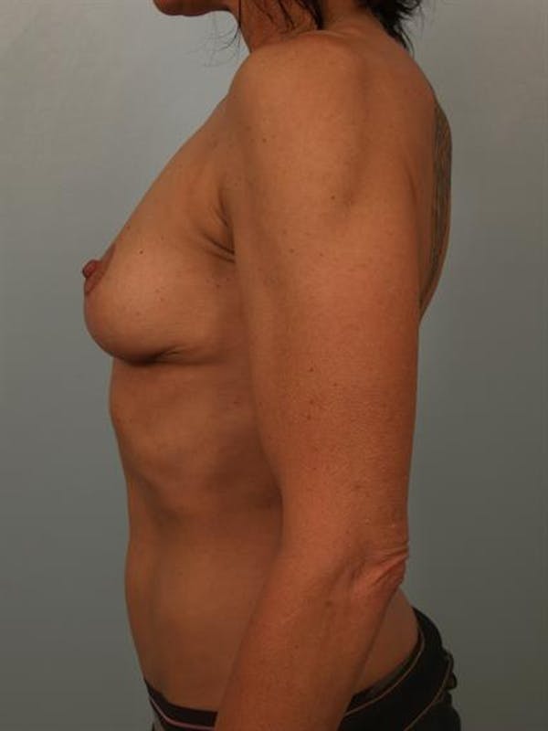 Complex Breast Revision Before & After Gallery - Patient 1310538 - Image 6