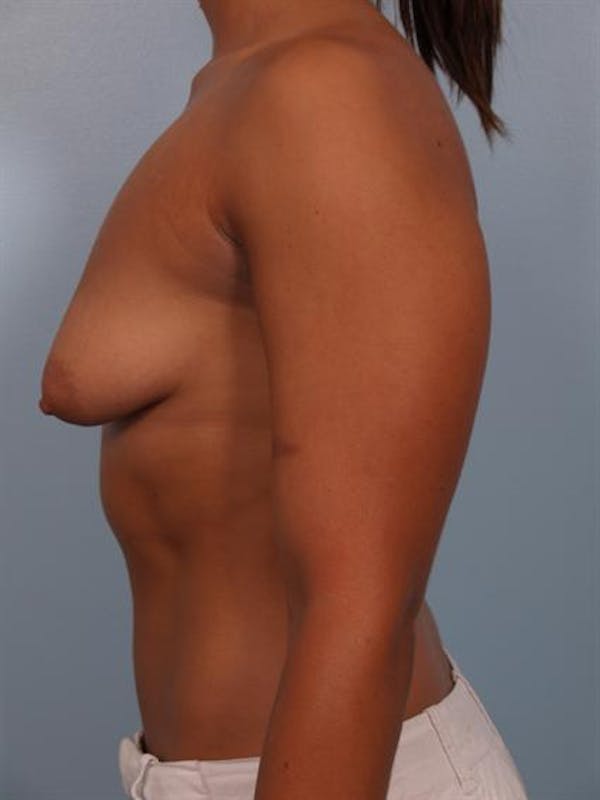 Tuberous Breast Surgery Before & After Gallery - Patient 1310539 - Image 5