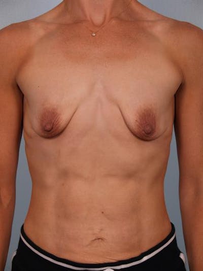 Breast Lift Before & After Gallery - Patient 1310542 - Image 1