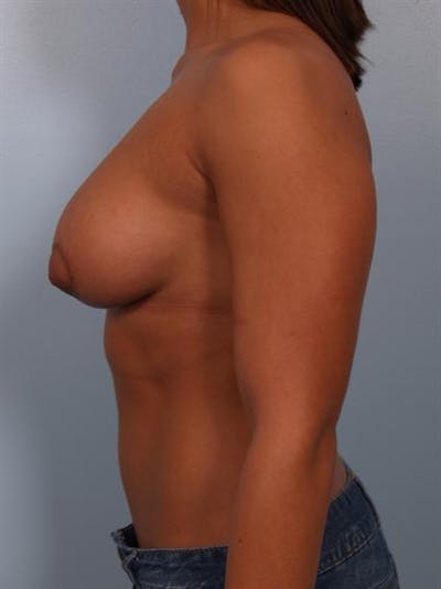 Tuberous Breast Surgery Before & After Gallery - Patient 1310539 - Image 6