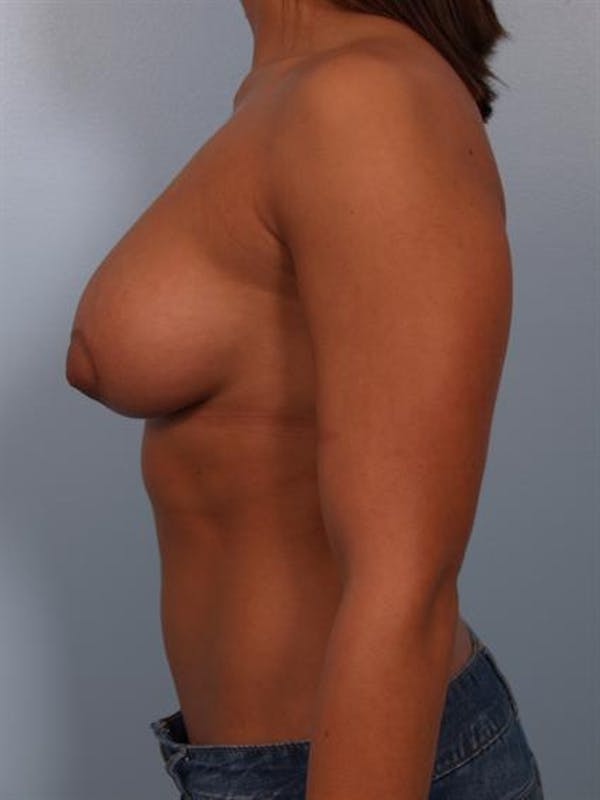 Tuberous Breast Surgery Before & After Gallery - Patient 1310539 - Image 6