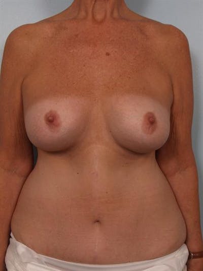 Complex Breast Revision Before & After Gallery - Patient 1310544 - Image 1